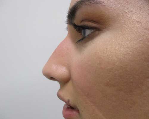 Liquid Rhinoplasty Before & After