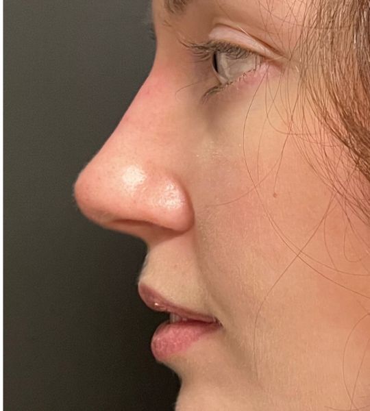 Liquid Rhinoplasty Before & After